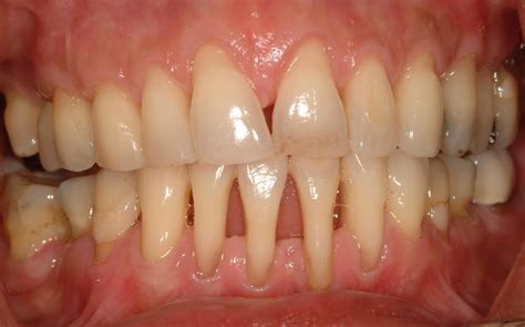 periodontitis leve-4